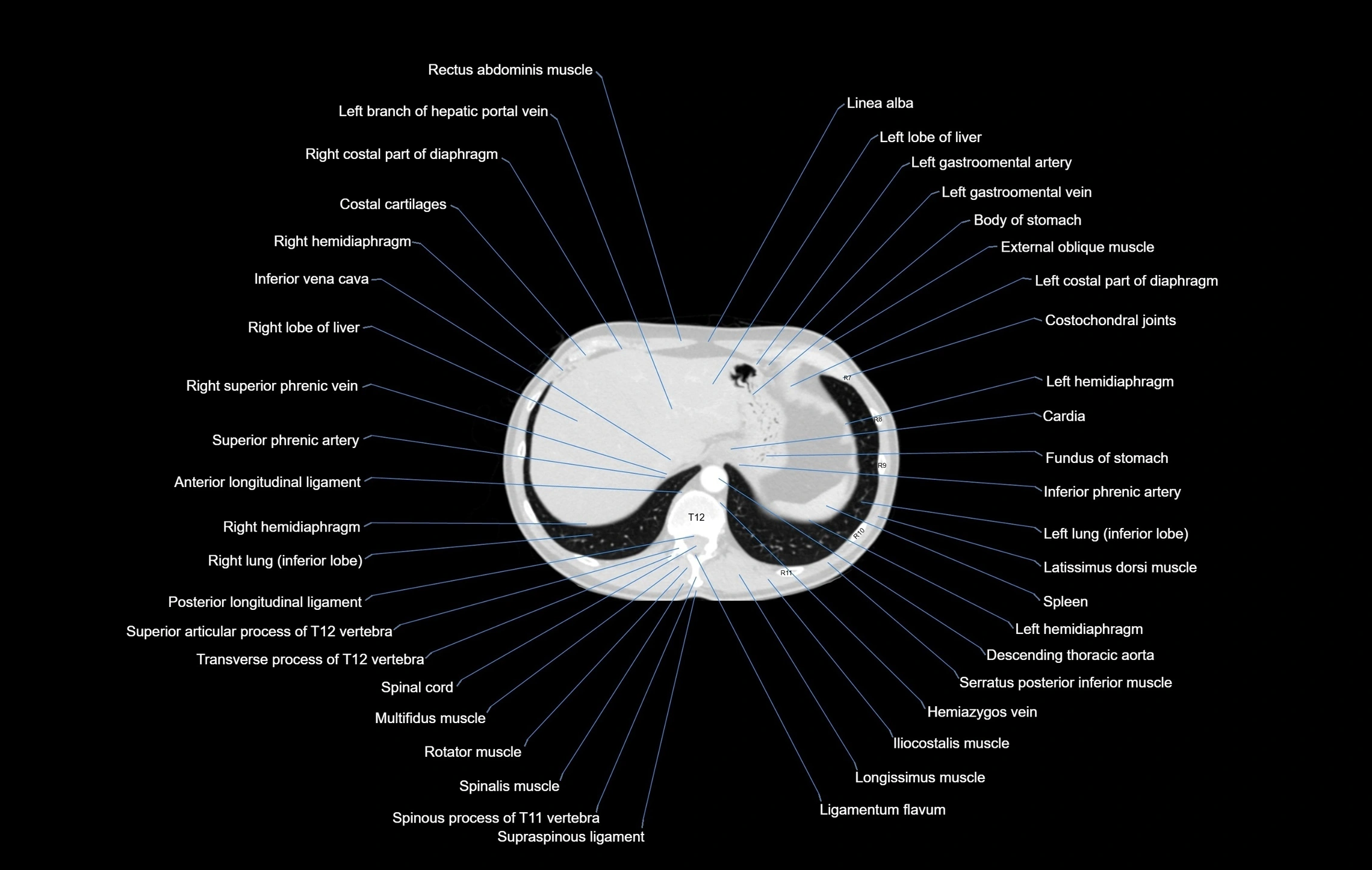 CT chest (thorax) labelled axial cross sectional anatomy radiology image-00107.webp